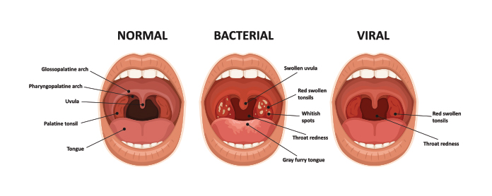 types of tonsil infections